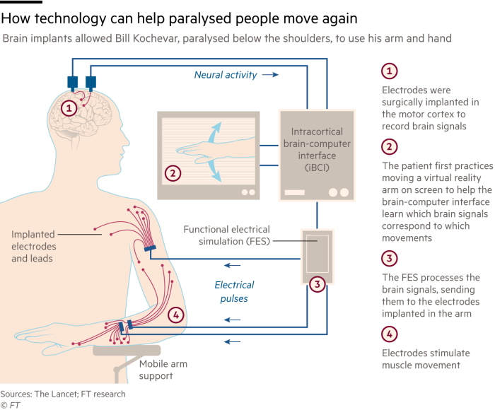 Infographic showing how technology can help paralysed people move again