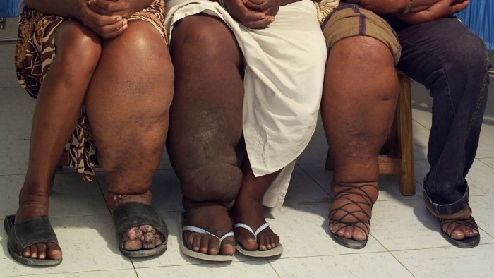 LEOGANE, HAITI - MAY 25: Three female patients of Dr. Luccene Desir, director of the Center of Research for Filariasis in Haiti (elephantiasis) display their legs affected by elephantiasis at a hospital in Leogane, south of Pt-au-Prince, Haiti. Left to right are Amise Placide, Poline Guerrier, and Mimose Louissant. The doctor's patients come from the locale of Leogane where research has shown that 40% of the population suffers from this maladie caused by a virus from mosquitos. The virus can live in the body for many years before developing into a permanent swelling, usually in the legs of women, and elsewhere in men. Some of the women recognized that the malady came from mosquitos but others thought they came from a curse or spell put on them. (Photo by Maggie Steber for The Washington Post via Getty Images)