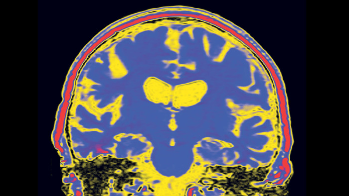 Coloured MRI scan of a coronal (vertical) section through a brain with Alzheimer's disease