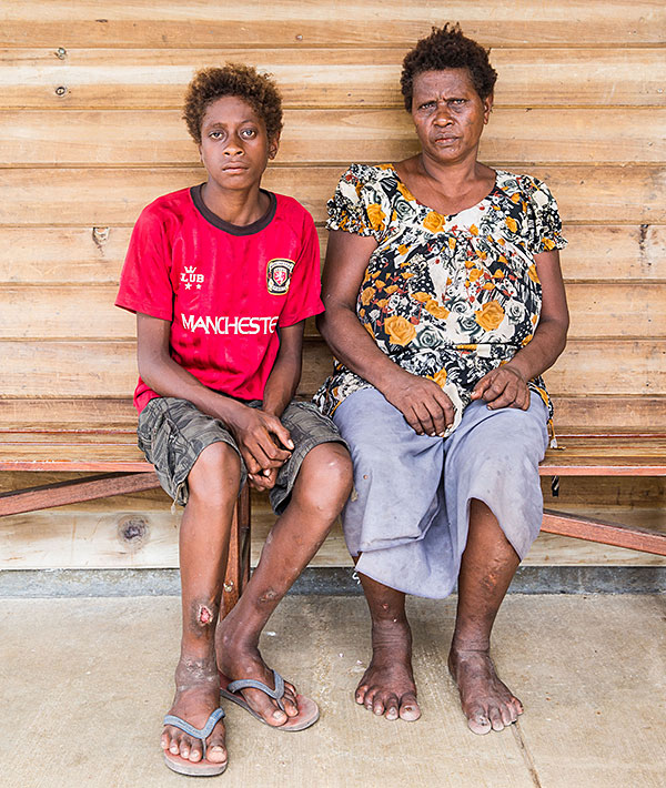 Chronic symptom: Stanis Malome and his mother. Yaws, initially untreated, has left him with a open wound on his leg