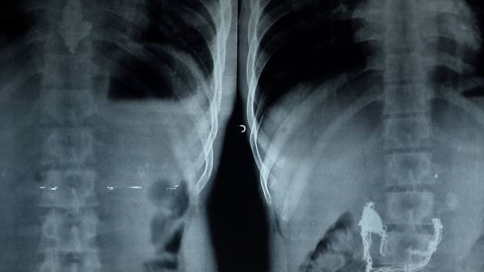 Dean of Mumbai's Lokmanya Tilak Medical College and Hospital (Sion hospital) Suleman Merchant inspects x-rays showing a pendant and necklace lodged inside the stomach of Anil Jadhav in Mumbai on May 1, 2015. Jadhav, an alleged thief who swallowed a gold necklace after snatching it from a housewife, has expelled it in his faeces after he was fed special liquids and more than 60 bananas.  Jadahav was administered four enemas by the doctors after X-ray scan of his abdomen showed the necklace worth INR 63,000 (USD 1,000)lodged in his stomach.  AFP PHOTO/ Indranil MUKHERJEE        (Photo credit should read INDRANIL MUKHERJEE/AFP/Getty Images)