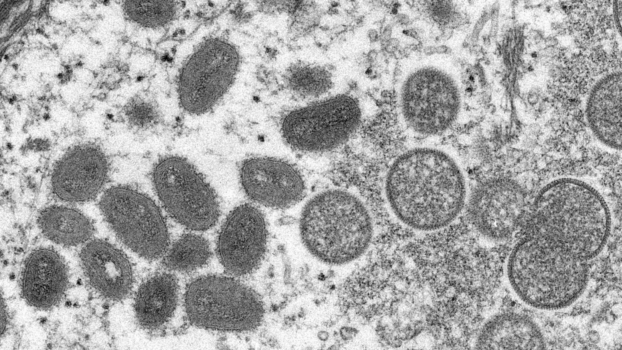 US records first monkeypox case since virus reported in Europe