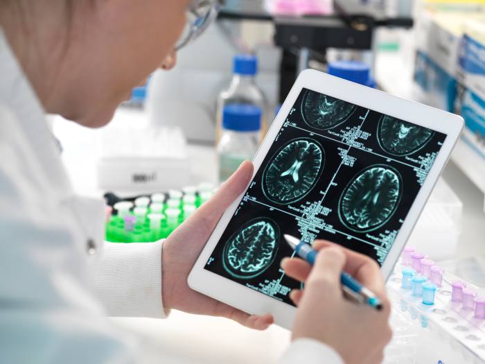 Preallarme: le scansioni MRI possono essere analizzate utilizzando l'intelligenza artificiale per aiutare a rilevare i primi segni di Alzheimer