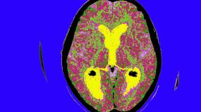 Biogen and Eisai shares surge after Alzheimer’s drug trial success image